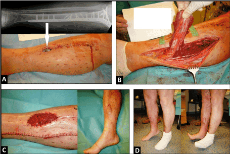 Self-Harm Scar Removal Insurance Ccoverage: What You Need to Know